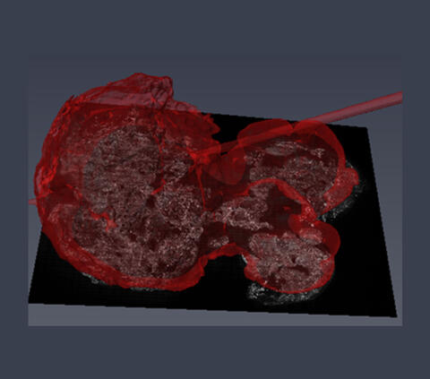 Prostate Fused